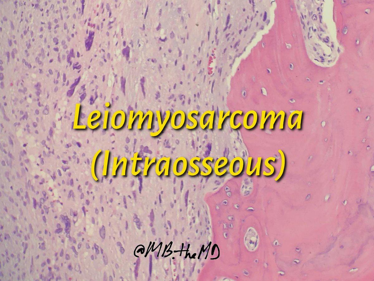 MB_thepathMD's tweet photo. #pathology #pathologist #pathfellow #pathresident #pathArt #boneandsofttissue #leiomyosarcoma https://t.co/sz1UloArLU