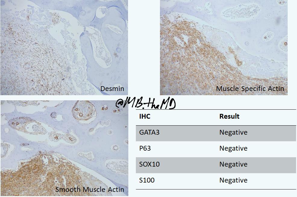MB_thepathMD's tweet photo. #pathology #pathologist #pathfellow #pathresident #pathArt #boneandsofttissue #leiomyosarcoma https://t.co/sz1UloArLU