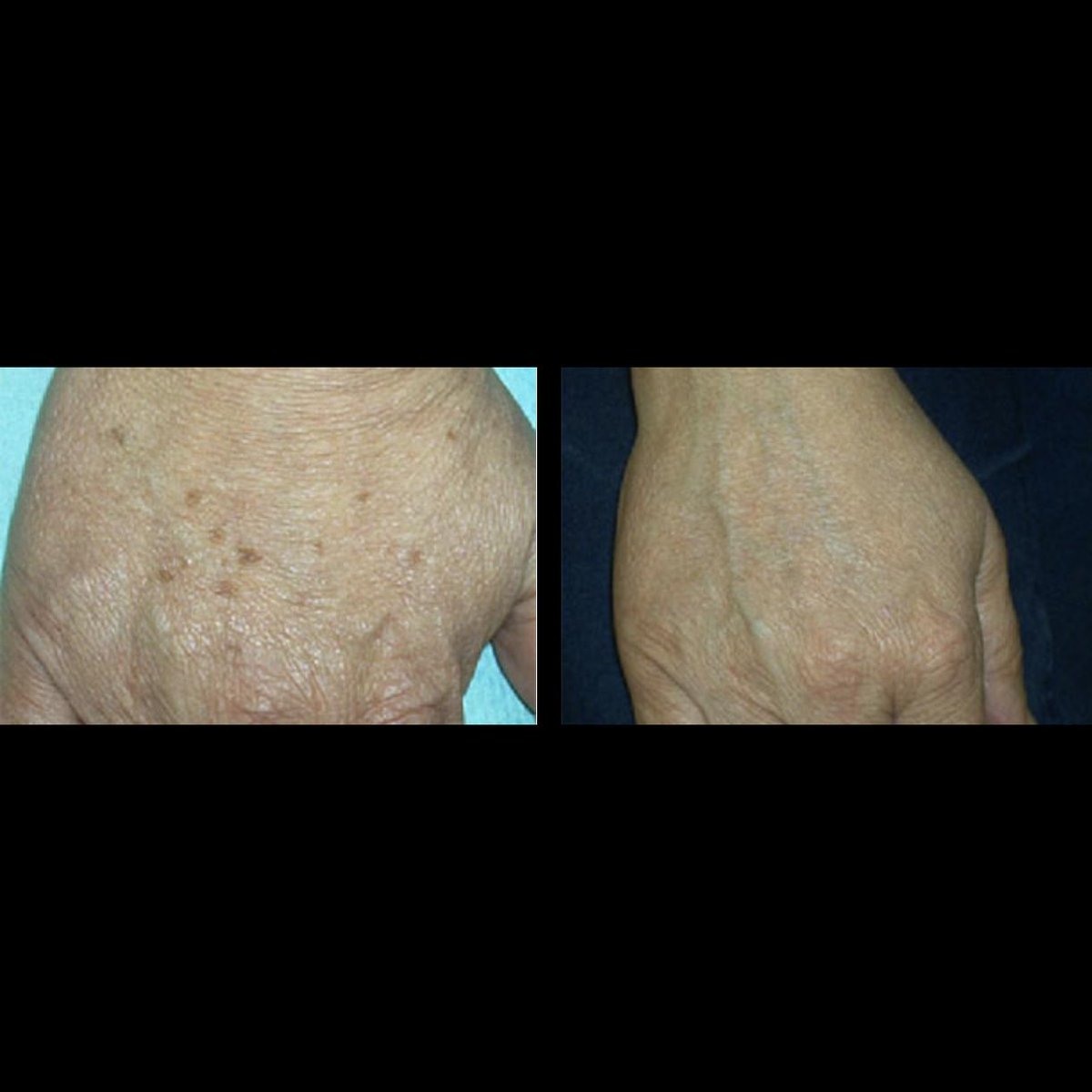 nclpleeds's tweet photo. LIVER SPOT REMOVAL
Laser technology uses a light beam that's absorbed by the darker pigmented spot on the skin. That spot then sloughs off, leaving fresh, healthy skin beneath. The laser does not damage the skin. The treatment is non-invasive, no needles, no cutting, no bruises. https://t.co/A0w0tylA0E