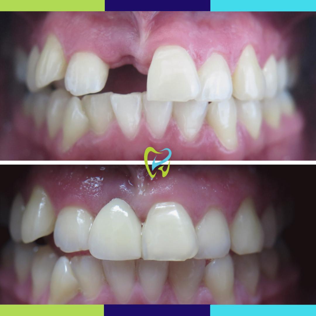 Lose a tooth or multiple teeth? We can help with that! Contact us today to learn more about our Dental Implants. dentistoftorrance.com/dental-implant…

310-651-7660
dentistoftorrance.com