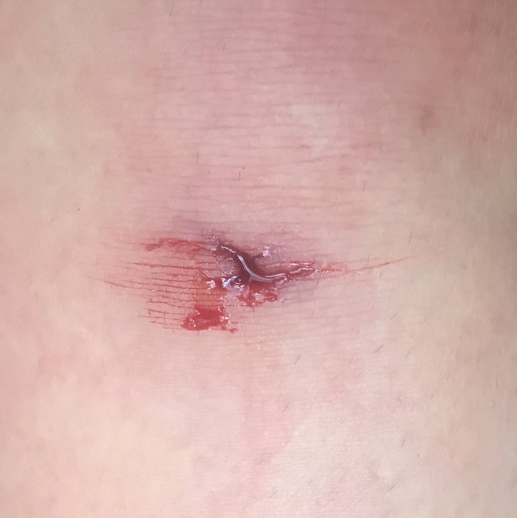 ParryEira's tweet photo. Went running in the woods, fell over #clumsy. Made a big bloody hole in my knee, but THANK GOD I didnโt make a hole in my @queenbathletics Daisy leggings! #priorities #kneeshealleggingsdont #ouch #nobodysaw #bestleggings https://t.co/VW4nF26kYs