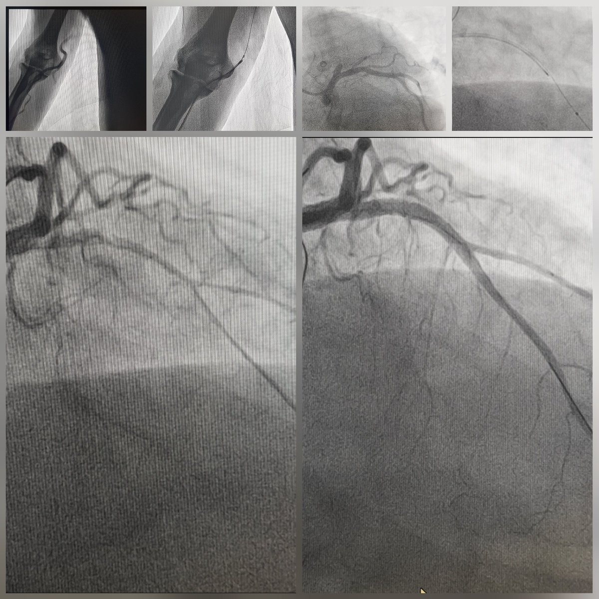 mornei2011's tweet photo. 👨🏽71y, AS STEMI, #Radialfirst🎈🦇, flow recovery with🎈 2 x 15 mm, ¿What size stent would you use? Decision making with IVUS #Opticross, #Synergy 2.75x20mm, Synergy 3.5x 24mm, 🎈NC 4x15mm... Final Result. @BSCCardiology @AlcantaraCardio @srita_guacamole @cesarahp1 @dr_alexfdez https://t.co/liG4Yc8xZO