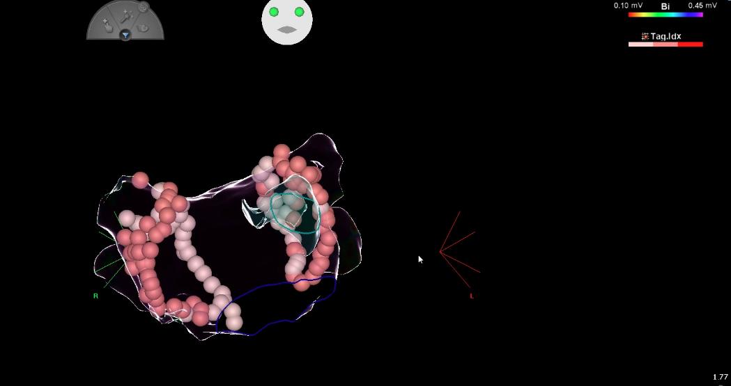 Aperezsilva77's tweet photo. First 8 cases of #PVI in Latin America using #Visitag #SurPoint technology. #Carto 3. Concepción-Chile. Happy to be part of this great team.  @LAHRSonline1 @BiosenseWebster @HRSonline @Conxalonso @andresenriqueza @jacabreracardio @ALFIEEP1 @DrFerminGarcia @WCA20191 https://t.co/nqp1r9mK5w