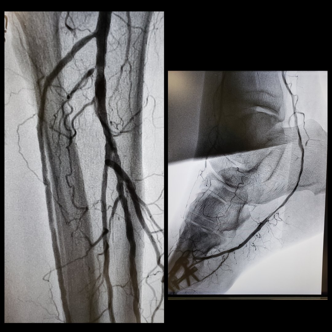 JVargheseMD's tweet photo. #CLI 50 M, with non-healing surgical wound on big toe from Dec. Referred by podiatry. Antegrade CFA access, opened CTO in AT, PT, and DP. Pt excited to walk out of the hospital w/o amp! #Angiosome #CLIFighters @baileyannRN @Mustapja @kmadass @FadiSaab17 @raosid https://t.co/rDuctsYWPS