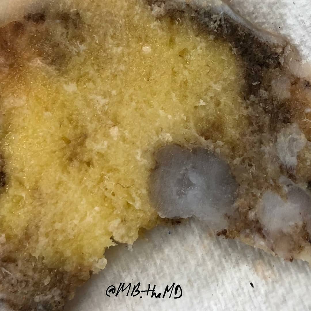 MB_thepathMD's tweet photo. #pathology #pathfellow #pathresident #pathologist #pathArt #Boneandsofttissue https://t.co/vLHdKSJXUv