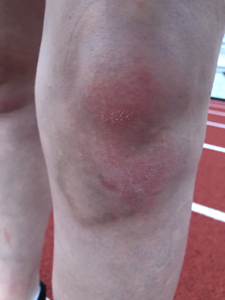 I fell playing wiffleball. Let’s see if this swollen knee can make it up to school tomorrow...