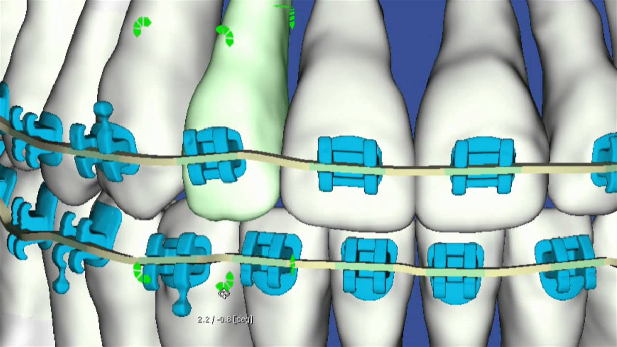 Our patients want to see results in as little time as possible. That's why we're the FIRST chosen clinic in the UK to offer treatments backed by SureSmile technology. Find out more on how we achieve Orthodontic results here: qoo.ly/yx9ug