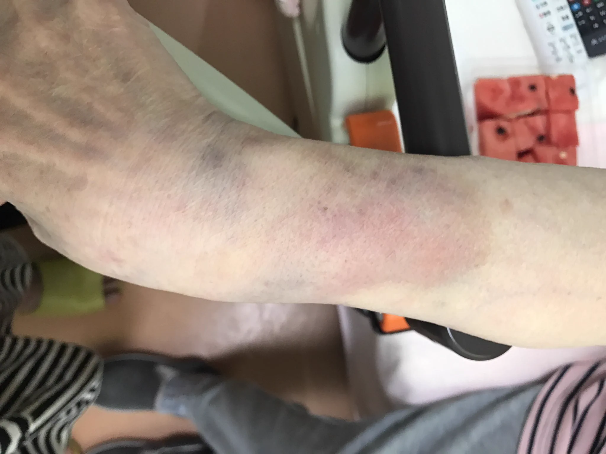 母親が施設で頭部・腕にあざができている・警察に被害届出すか迷っている。