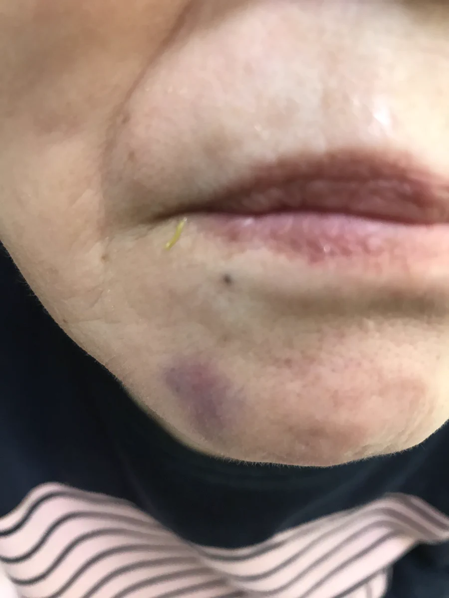 母親が施設で頭部・腕にあざができている・警察に被害届出すか迷っている。