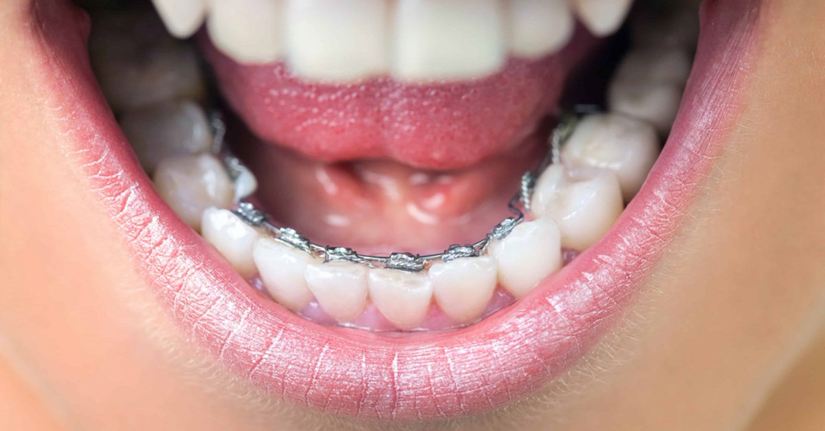 Have you heard your friends talking about braces that go behind the teeth? Lingual braces are  fixed braces attached to the back of the teeth making them discreet; plus they are now just as efficient as the traditional braces! Find out more here: qoo.ly/yxq4f