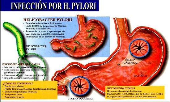 Gastritis crónica es para siempre