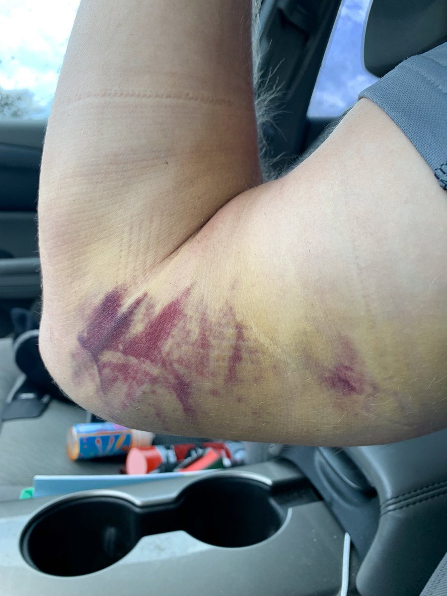 CoachMingie's tweet photo. Some of you know I’ve been out of the gym for a few months. I suffered one of the worst limb injuries from football I’ve ever had. Today I started back and failed to complete my workout. I WILL complete it next time. The grind has started back 😴😴😴 https://t.co/tZpwA9Jqzj