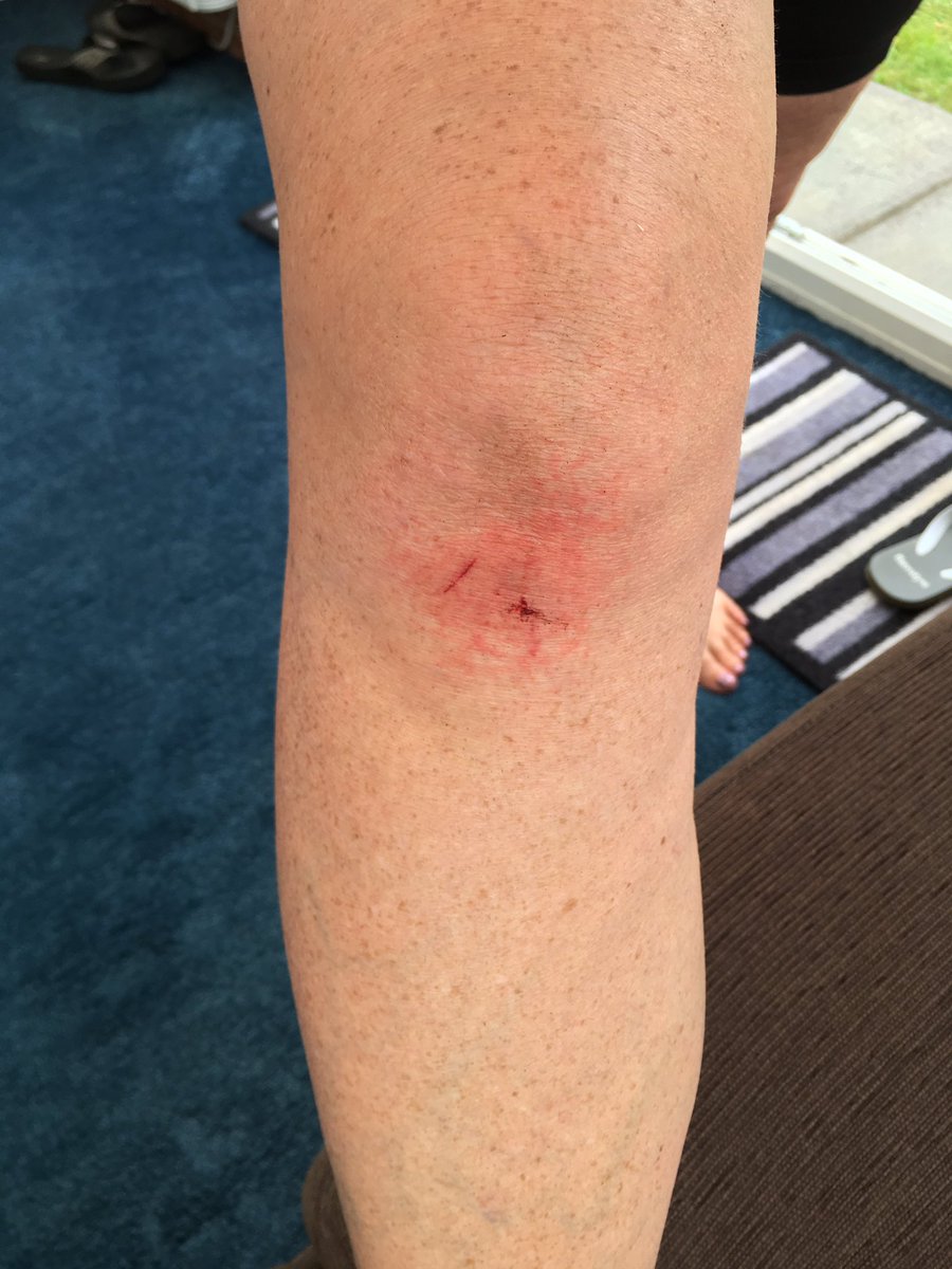 AbbiPolls's tweet photo. Training Ride for next week’s @NorfolkCyclingE #NorfolkSportive Ride4 #7Ridesin7Months #7Rides400miles pity about little crash #uncleatBeforeStopping https://t.co/SGGtdxxfVF fundraising @NNUHCharity @NCHC_NHS #skincancerpatients #strokevictims #iamaradiographer @SCoRMembers https://t.co/vKq8945TmS