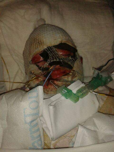 TheOrangeFamily's tweet photo. #August #SjsAwareness #AugustStevensJohnsonSyndromeAwarenessMonth #SJS #blooddonation #BloodDonors #Donors #Blood #StevensJohnsonSyndrome #ToxicEpidermalNecrolysis #TEN #TENS @YoungOakley13 #SjsSurvivor since #December2013 #LiveToFightAnotherDay #Survivor #Survival @GiveBloodNHS https://t.co/YCm6P6bSzX