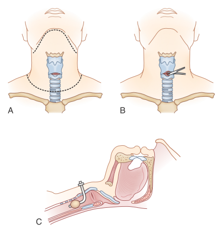 medsupernotes's tweet photo. Technique of Cricothyroidotomy : (A).The  incision  and  dissection  are  continued through the cricothyroid membrane and the cricothyroidotomy is spread (B),allowing the passage of a tracheal tube (C) 
#plab1 #medschool #usmlestep1 #usmlestep2 #nextnotes #nexthighyield #mbbs https://t.co/bme8yXUy2L