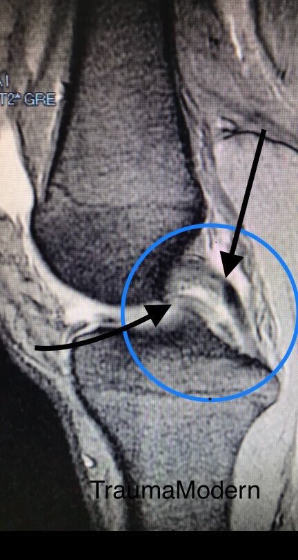 trauma_modern's tweet photo. Signo del doble #ligamento #cruzado posterior: Se produce por la rotura longitudinal del #menisco (interno en este caso),con desplazamiento de la porción medial a la fosa intercondílea. Imágenes de resonancia, menisco luxado y reducción del mismo #TraumaModern #menisco #rodilla https://t.co/NyTSqmSyv4
