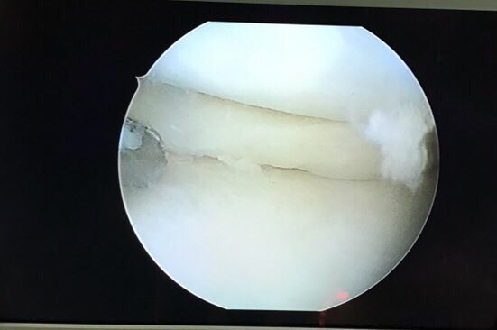 trauma_modern's tweet photo. Signo del doble #ligamento #cruzado posterior: Se produce por la rotura longitudinal del #menisco (interno en este caso),con desplazamiento de la porción medial a la fosa intercondílea. Imágenes de resonancia, menisco luxado y reducción del mismo #TraumaModern #menisco #rodilla https://t.co/NyTSqmSyv4