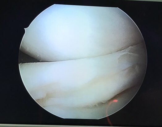 trauma_modern's tweet photo. Signo del doble #ligamento #cruzado posterior: Se produce por la rotura longitudinal del #menisco (interno en este caso),con desplazamiento de la porción medial a la fosa intercondílea. Imágenes de resonancia, menisco luxado y reducción del mismo #TraumaModern #menisco #rodilla https://t.co/NyTSqmSyv4