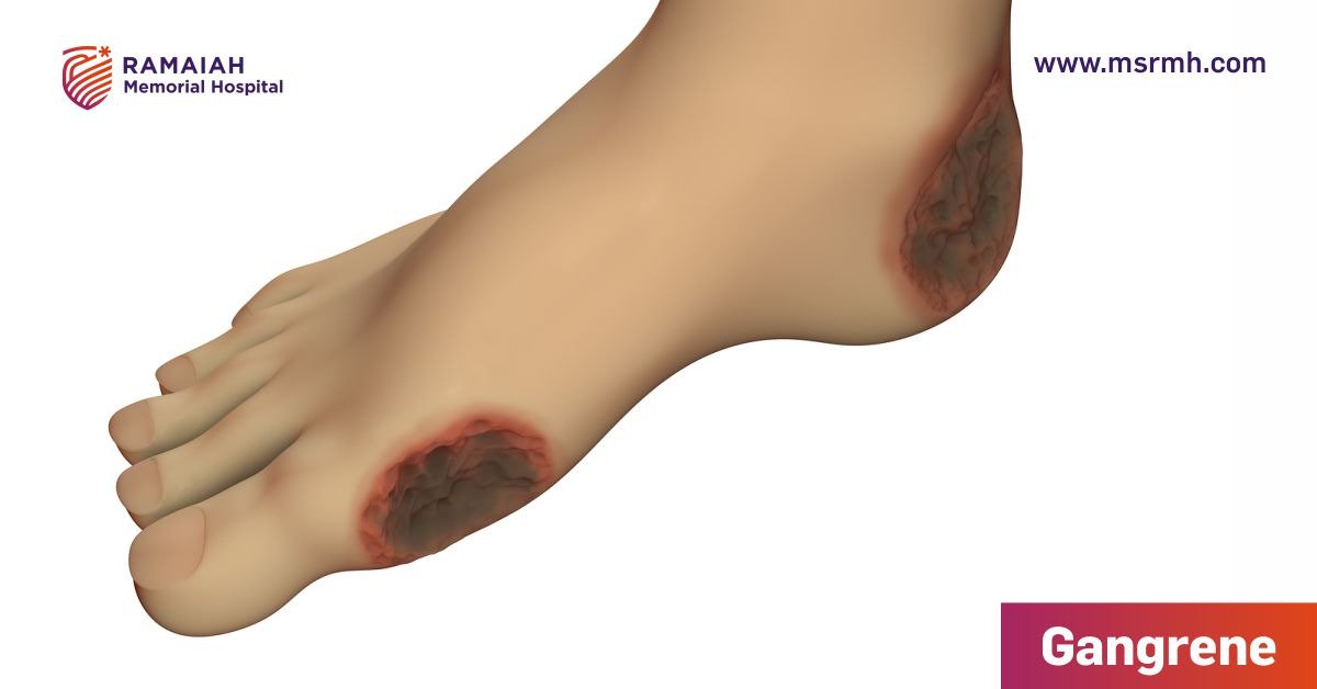 MSRMHOfficial's tweet photo. #Gangrene occurs when a #bodytissue #decomposes & stops functioning. It is caused by loss of #blood supply due to an #illness, #injury or #infection.
#RMH #ramaiahmemorialhospital #Gangrene
Read more -
https://t.co/HVgIealYAL https://t.co/gQG8axuNqE