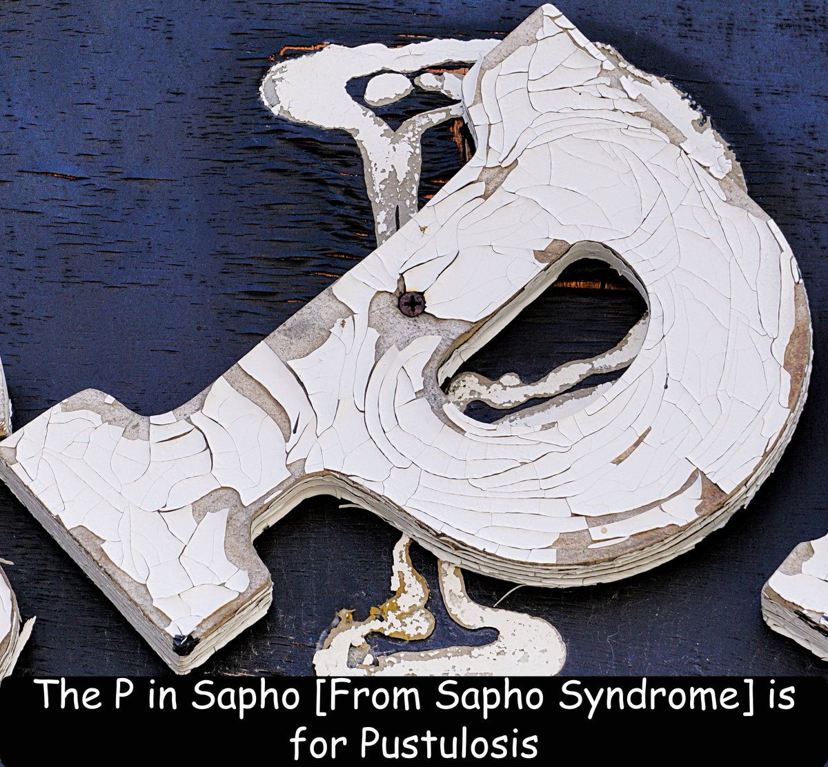 MAutoimmune's tweet photo. The P in Sapho stands for Pustulosis, an inflammatory skin condition resulting in fluid-filled blisters, or pustules. Pustulosis typically occurs on the palms of the hands and/or the soles of the feet
#pustulosis #sapho #saphosyndrome #autoinflammatory #mrautoimmune #chronicpain https://t.co/ix8vgOqmMy
