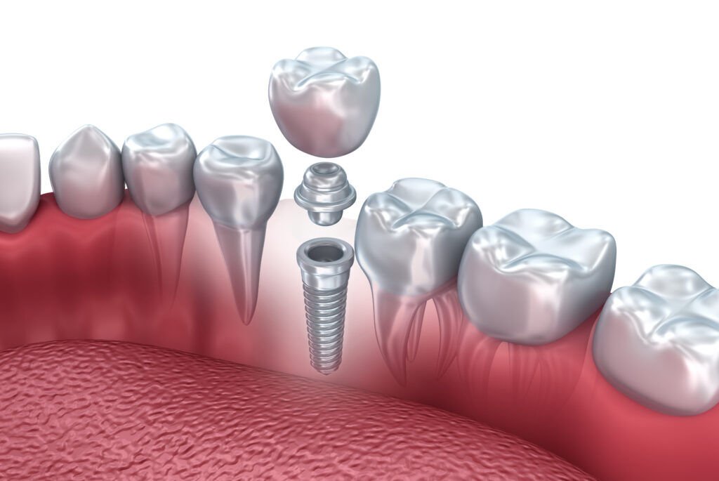 Mini Dental Implants: What are they, who can be a candidate and how much do they cost?

bit.ly/2OJiAiy