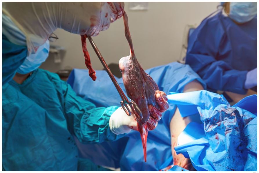 Placental bacteria not linked to adverse pregnancy outcomes. 
mdedge.com/obgyn/article/…