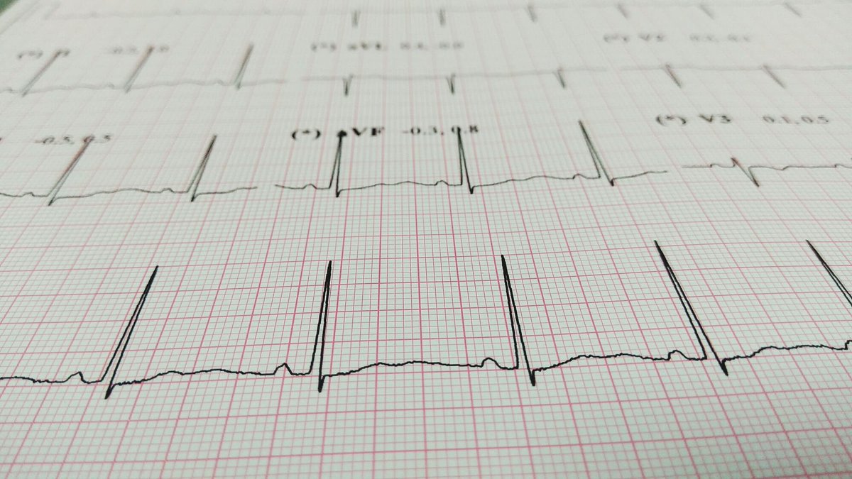 Core_EM's tweet photo. Core Content: Brugada Syndrome by @max_b31 

https://t.co/thO99qA6UB

#FOAMed #MedEd #Rhythm https://t.co/yAOKfnj2dO