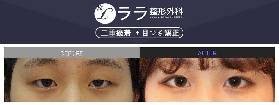 ララ美容整形外科 Di Twitter 患者さん 個人の顔に合う二重整形を行います 可愛いイメージに変わりました 二重癒着 目つき矯正 ララ整形外科 ララ美容外科 韓国整形外科 韓国整形イベント 二重 ふたえ 二重整形 二重手術 症例写真 ビフォー