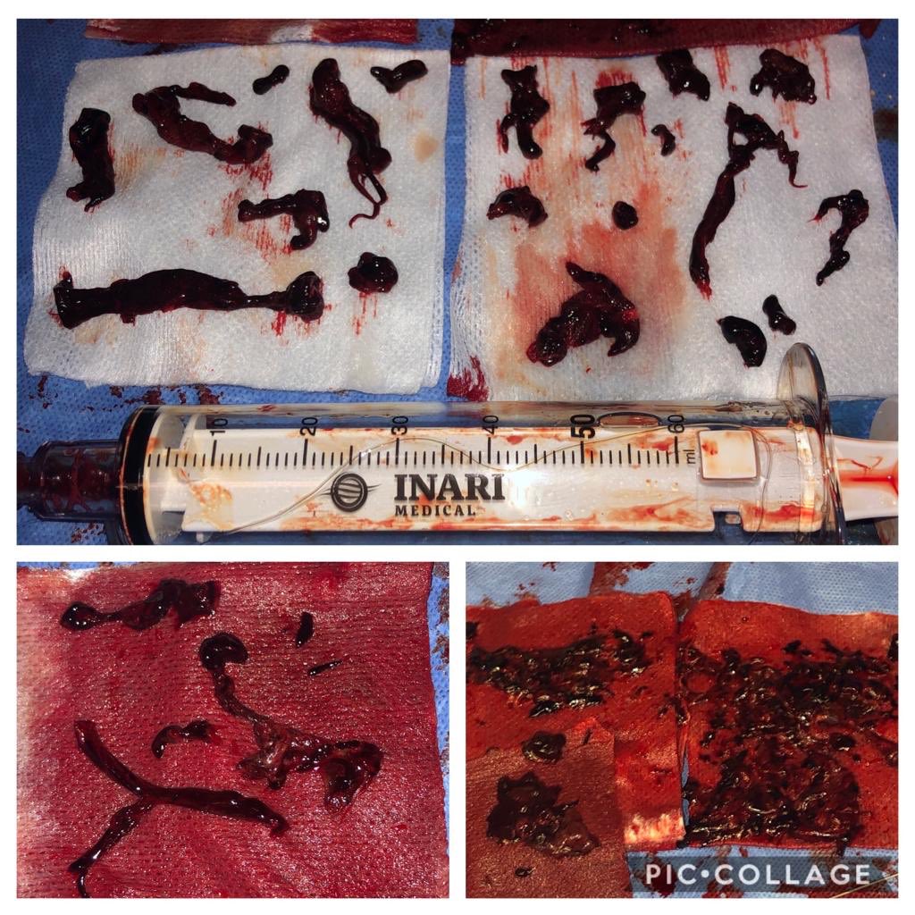 Carin Gonsalves, MD, FSIR (@carin_gonsalves) on Twitter photo Submassive PE with RV strain, chest pain, SOB. S/P FLOWTRIEVER off O2, asymptomatic, normal ECHO. Very proud of our PERT program <a href="/TJUHospital/">Jefferson Health</a> <a href="/JeffersonRads/">Jefferson Radiology</a> <a href="/BAwsare/">Bharat Awsare</a> @RichWebsterTJUH <a href="/RonaldWinokurMD/">Ronald Winokur, MD, FSIR, FAVLS, RPVI</a> <a href="/fischman_david/">David L. Fischman</a> Submassive PE with RV strain, chest pain, SOB. S/P FLOWTRIEVER off O2, asymptomatic, normal ECHO. Very proud of our PERT program <a href="/TJUHospital/">Jefferson Health</a> <a href="/JeffersonRads/">Jefferson Radiology</a> <a href="/BAwsare/">Bharat Awsare</a> @RichWebsterTJUH <a href="/RonaldWinokurMD/">Ronald Winokur, MD, FSIR, FAVLS, RPVI</a> <a href="/fischman_david/">David L. Fischman</a> 