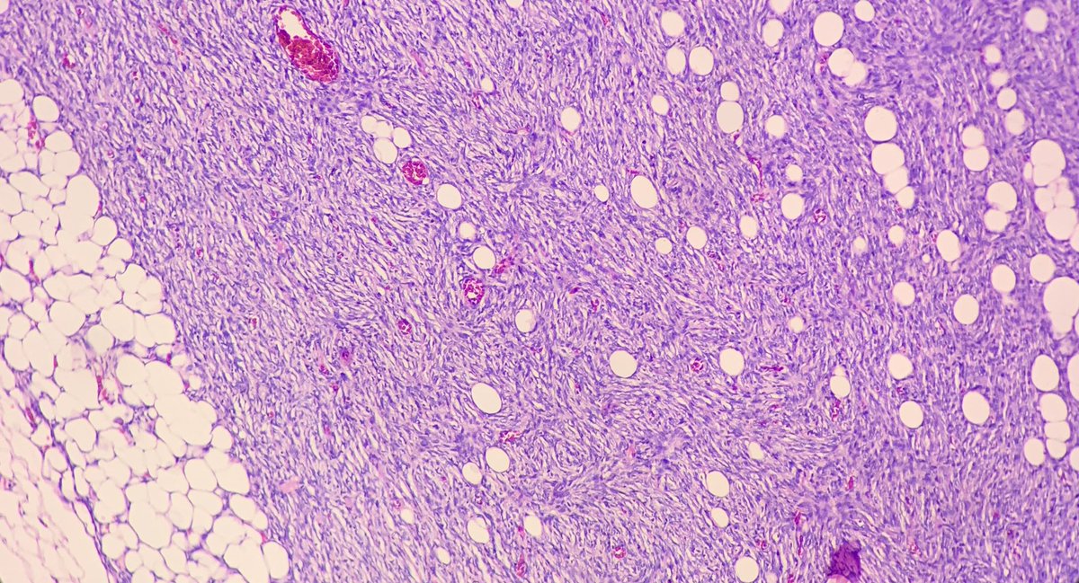 AyeWonn's tweet photo. Male breast lump, your diagnosis? https://t.co/E75jTqdltd
