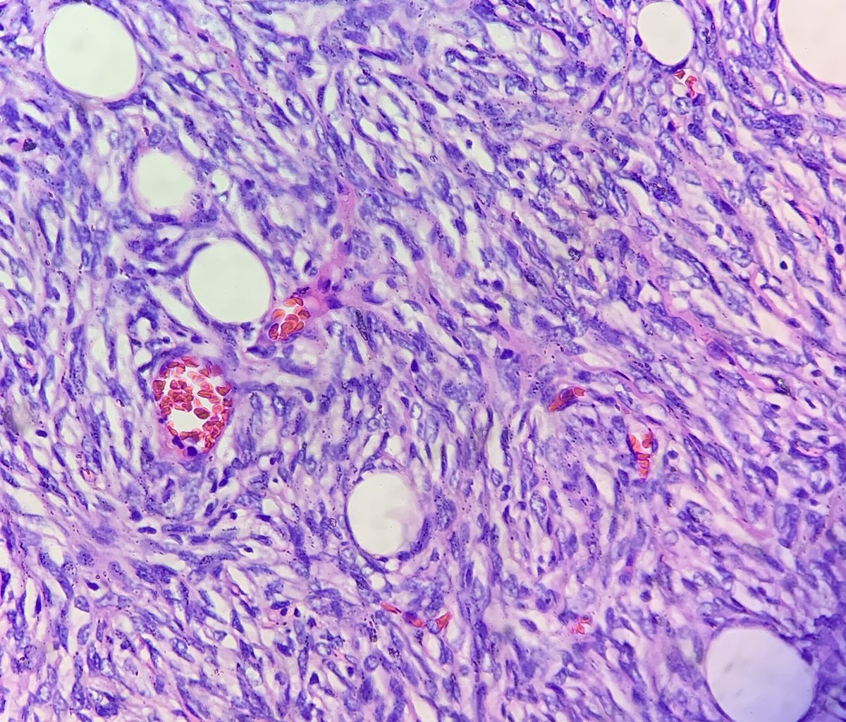 AyeWonn's tweet photo. Male breast lump, your diagnosis? https://t.co/E75jTqdltd