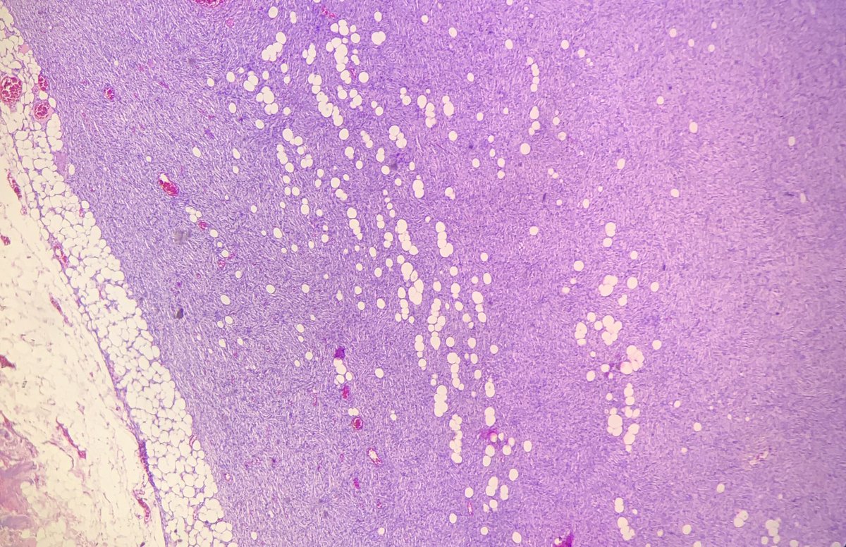 AyeWonn's tweet photo. Male breast lump, your diagnosis? https://t.co/E75jTqdltd