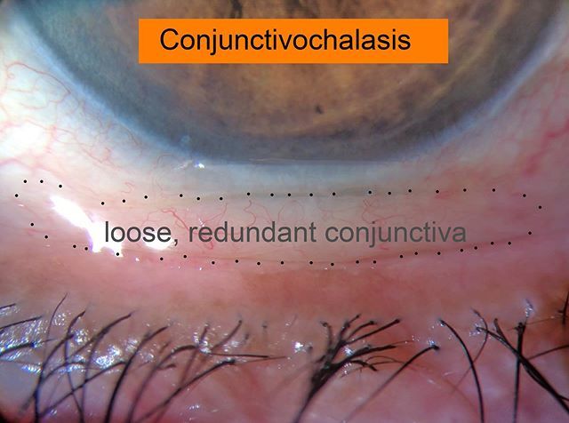 Zocular's tweet image. Do you feel like there's something in your eye every time you blink?  You may have conjunctivochalasis (CCh), which are redundant folds of conjunctival tissue.  Chronic meibomian gland disease and dry eye can cause CCh.  Ask your doctor how ZocuShield ge… ift.tt/2YtNUpR