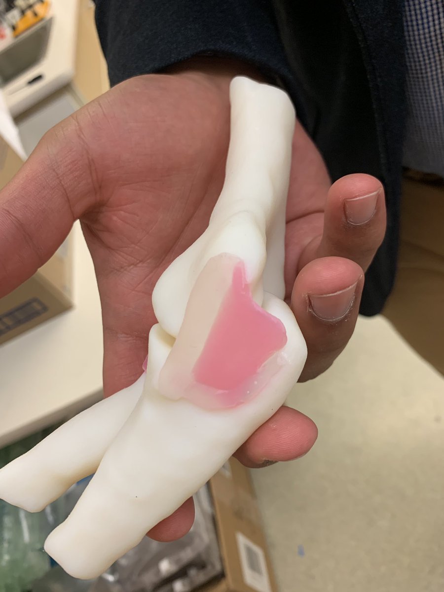 JayMorris_MD's tweet photo. Creating #3Dprinted #elbow #simulation tools for #education starts with #anatomically accurate  data. @MorrisnjNoah @MayoRadiology  created models from 32channel volumetric T2WI and ZTE #MRI merged w/ normal #volunteer CT @Ultimaker @Stratasys @formlabs @OrthoToday @3DOS4 @RSNA https://t.co/pcJLur7bkh