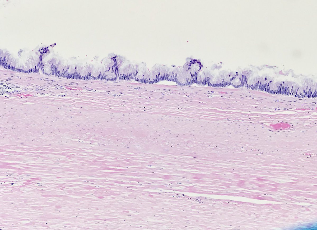 kabeerkshah's tweet photo. Took a deep dive into “mucocele” of the appendix - here’s a recap for next time:
1/ “Mucocele is not a pathologic diagnosis
**Terminology is confusing** - Some images from @ReetPaiMD1 - @TheUSCAP Course - https://t.co/vTTvf0r6pe
#GIPath https://t.co/x35gebWCgV