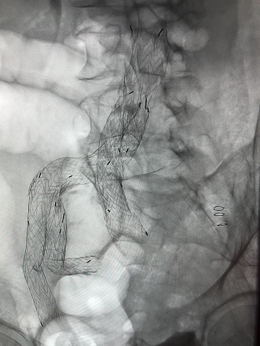 5280vascular's tweet photo. Pushing the conformability of the @WLGore IBE and the DrySeal Flex in treating complex aortoiliac aneurysmal disease with the additional benefit of hypogastric artery preservation. #wireup @TMCAvascular @MedCtrofAurora https://t.co/42rYNQfovn