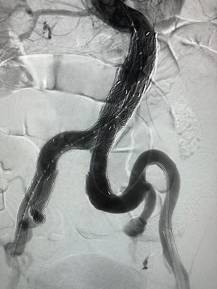 5280vascular's tweet photo. Pushing the conformability of the @WLGore IBE and the DrySeal Flex in treating complex aortoiliac aneurysmal disease with the additional benefit of hypogastric artery preservation. #wireup @TMCAvascular @MedCtrofAurora https://t.co/42rYNQfovn