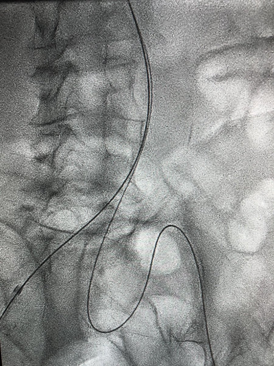 5280vascular's tweet photo. Pushing the conformability of the @WLGore IBE and the DrySeal Flex in treating complex aortoiliac aneurysmal disease with the additional benefit of hypogastric artery preservation. #wireup @TMCAvascular @MedCtrofAurora https://t.co/42rYNQfovn