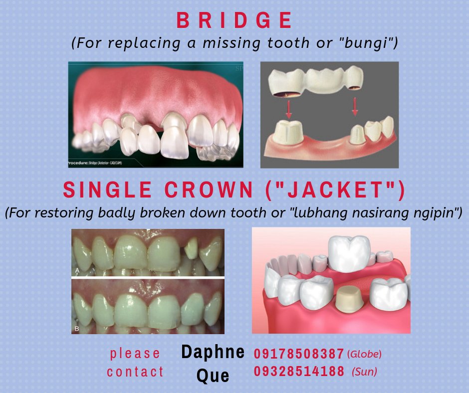 legenDaPhNe's tweet photo. Hi, I am a Junior Clinician in UP College of Dentistry. If you are in need of the dental services listed below or know someone who is. Please feel free to send me a message or inquiry 😊 https://t.co/5zhFsFFY0P