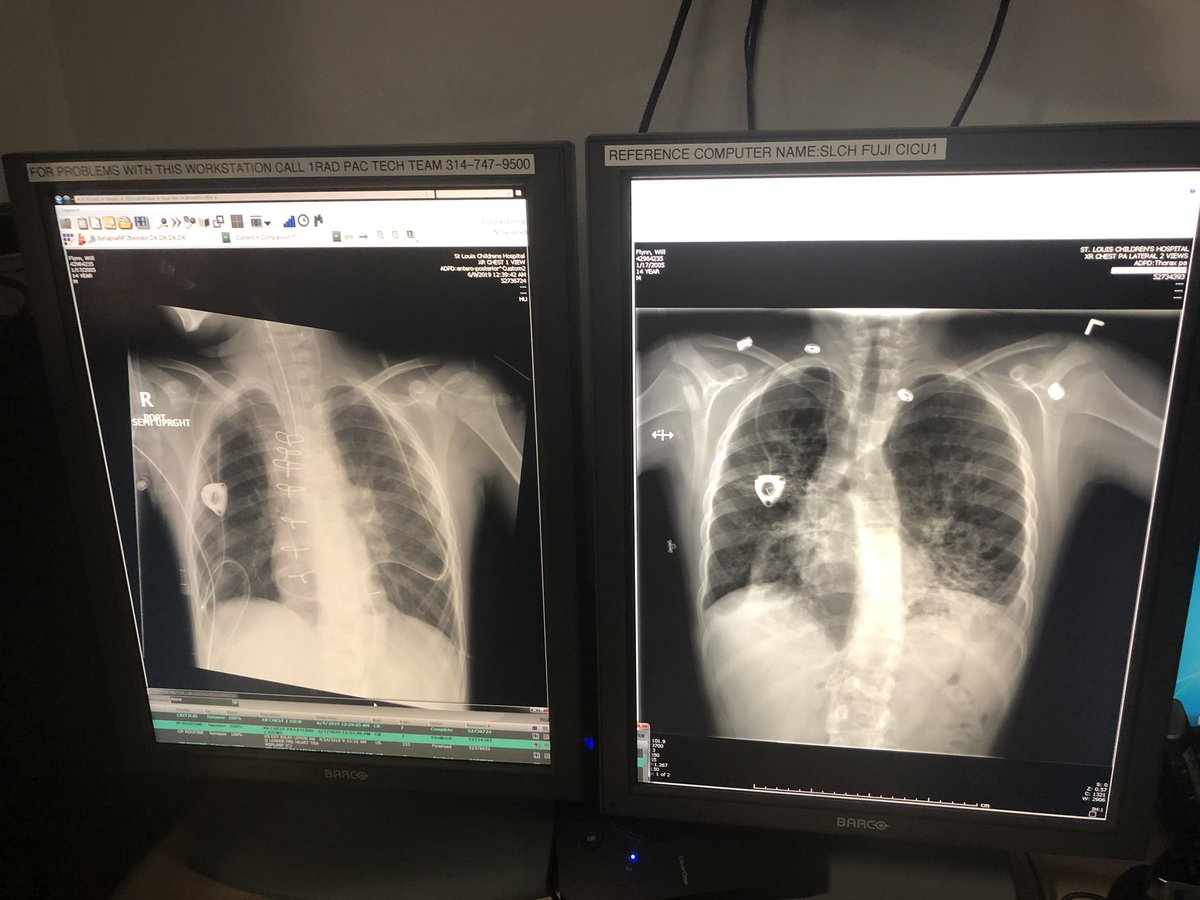 jtfx3's tweet photo. Check out https://t.co/nnS4815i7u for the on going story of Will Flynn and his summer in St. Louis. #Stl&amp;blue
#cysticfibrosis #OrganDonation @STLChildrens @CF_Foundation @DonateLife @LungTXfndtn https://t.co/jHx9k1piwA