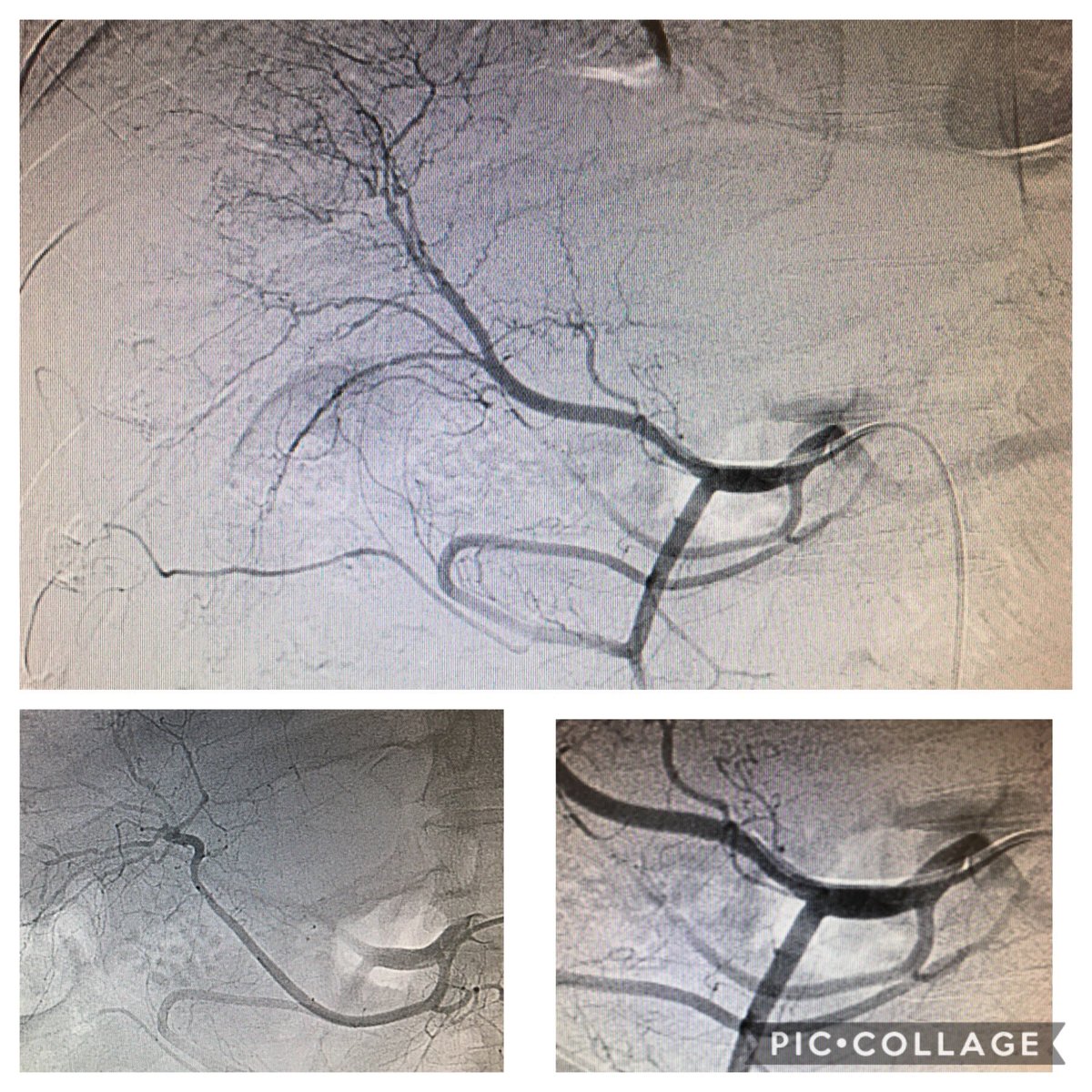 Guiro_IRad's tweet photo. Can someone tell which variant has this hepatic artery. #irad #tace #HCC @kike_rx @neumoyorch #Gitmi https://t.co/3W04j9Uoq6