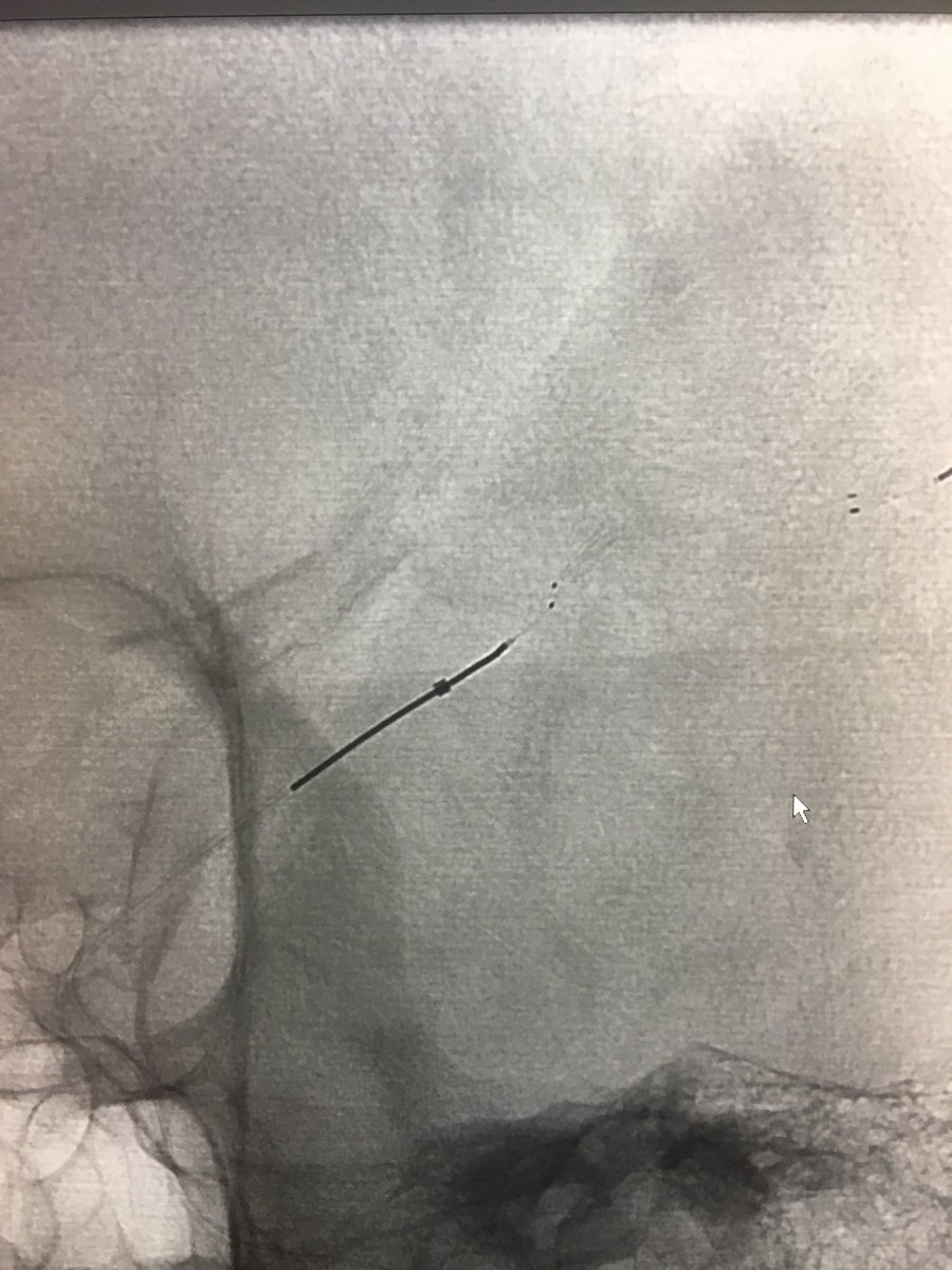 WayneOlan's tweet photo. 46 y/o female 3 hrs post LSW with NIHSS of 12. R hemiplegia/aphasia. L M2 cutoff. 2 to 1 mismatch on Rapid. #FirstPass #OnePass #EmboTrap 13 mins, skin to seal. 8hrs later talking and full strength!!! #LittleClotBigImpact Blessed to have the best team! #ItsBetterOn23rdStreet https://t.co/jeoMxonnHK