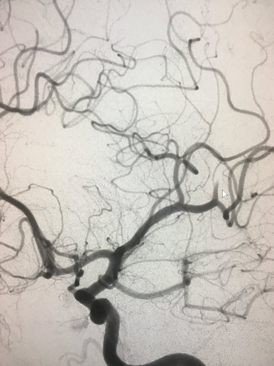 WayneOlan's tweet photo. 46 y/o female 3 hrs post LSW with NIHSS of 12. R hemiplegia/aphasia. L M2 cutoff. 2 to 1 mismatch on Rapid. #FirstPass #OnePass #EmboTrap 13 mins, skin to seal. 8hrs later talking and full strength!!! #LittleClotBigImpact Blessed to have the best team! #ItsBetterOn23rdStreet https://t.co/jeoMxonnHK