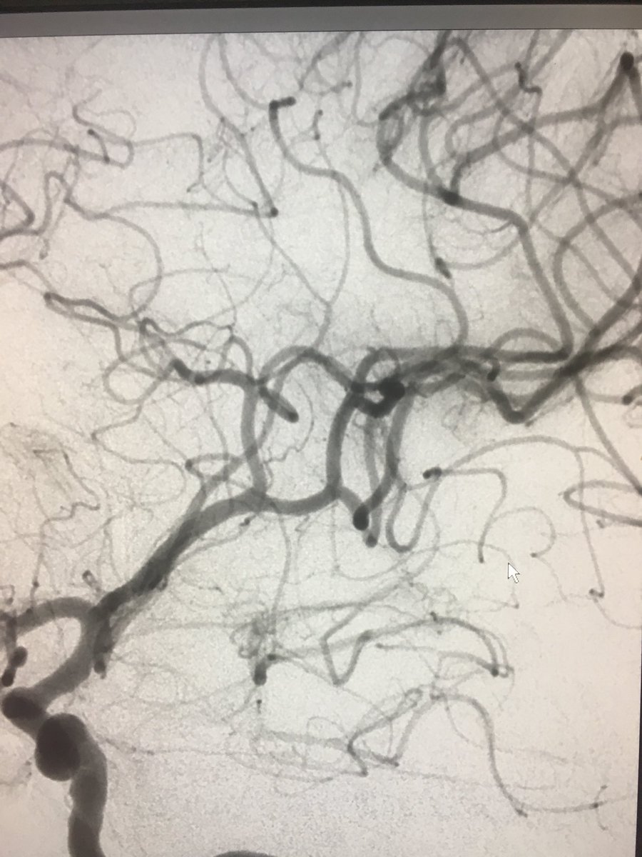 WayneOlan's tweet photo. 46 y/o female 3 hrs post LSW with NIHSS of 12. R hemiplegia/aphasia. L M2 cutoff. 2 to 1 mismatch on Rapid. #FirstPass #OnePass #EmboTrap 13 mins, skin to seal. 8hrs later talking and full strength!!! #LittleClotBigImpact Blessed to have the best team! #ItsBetterOn23rdStreet https://t.co/jeoMxonnHK