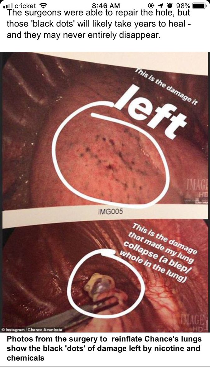 ambbwizzle's tweet photo. If juuling is a trend then the effects should be too. 1 year in this mans lung collapses and almost dies, I’ve been juuling for 3 years I can’t imagine how mine look, It’s never to late to change the way you treat your body. Stay woke kids. #stopjuuling https://t.co/akmGNWur72
