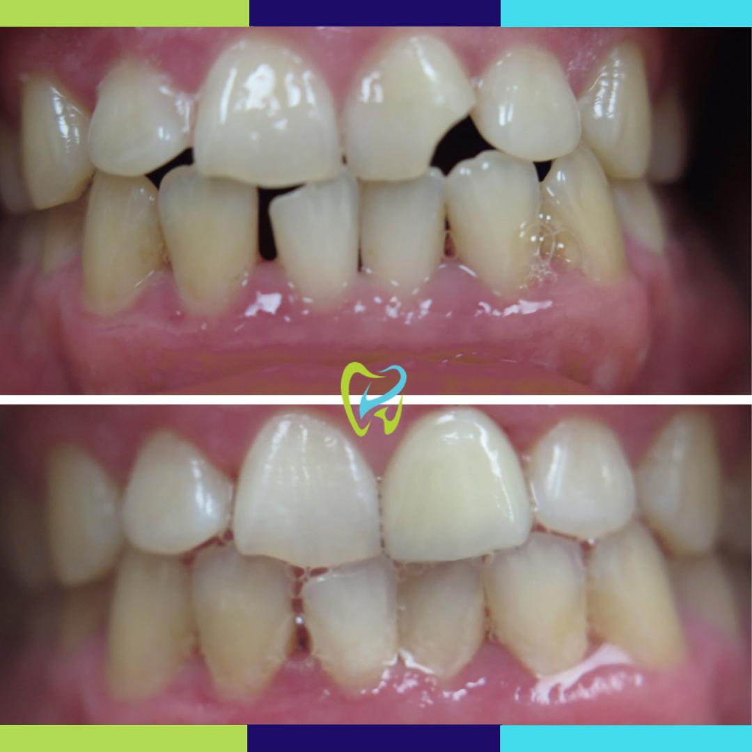 ESMDentistry's tweet photo. Have a chipped tooth? We can fix that! Contact us today to find out how. 

(424) 277-2671
https://t.co/oPJmYJd14S https://t.co/ruBjwBiZPN