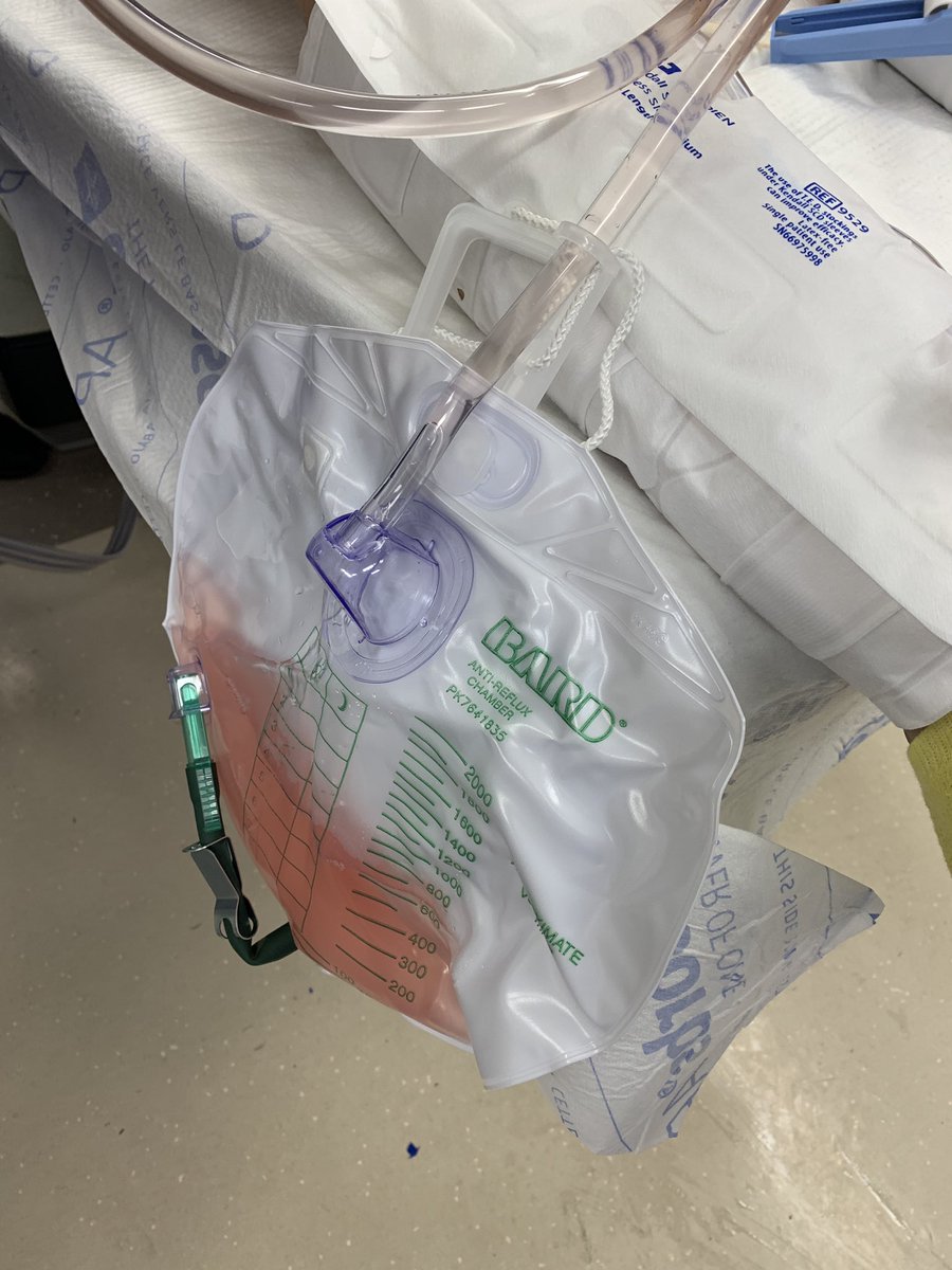 Deepak Agarwal (@drdagarwal) on Twitter photo Using new Moses modification from @LumenisU for HoLEP (“MoLEP”) today with <a href="/amy_krambeck/">Amy Krambeck</a>. 18 fr catheter running clear and same day discharge (catheter removal tomorrow in clinic). Win for patients and providers! <a href="/IUendourology/">IU Endourology</a> <a href="/IUuro/">Indiana University Department of Urology</a> #MoLEP #HoLEP #aeep #endourology Using new Moses modification from @LumenisU for HoLEP (“MoLEP”) today with <a href="/amy_krambeck/">Amy Krambeck</a>. 18 fr catheter running clear and same day discharge (catheter removal tomorrow in clinic). Win for patients and providers! <a href="/IUendourology/">IU Endourology</a> <a href="/IUuro/">Indiana University Department of Urology</a> #MoLEP #HoLEP #aeep #endourology