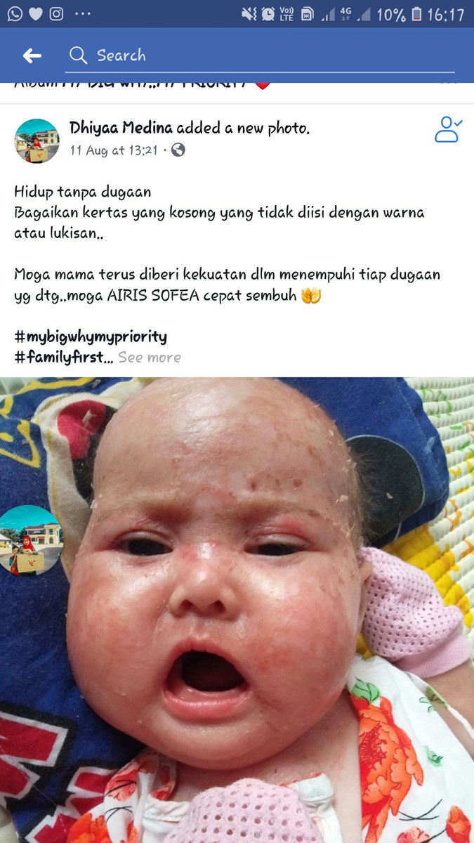 BisekutDinda's tweet photo. Assalamualaikum..disini saya memohon untuk doakan adik airis sofea sembuh dari masalah eczema yg teruk..sis dh pm akk ni untuk bagi sumbangan dan malah dia hanya minta org untuk doakan anak dia sembuh seperti sediakala.. 
.
Rt guys supaya lagi ramai nmpk dan sme sme doakan ❤️ https://t.co/KMigbeyJwM