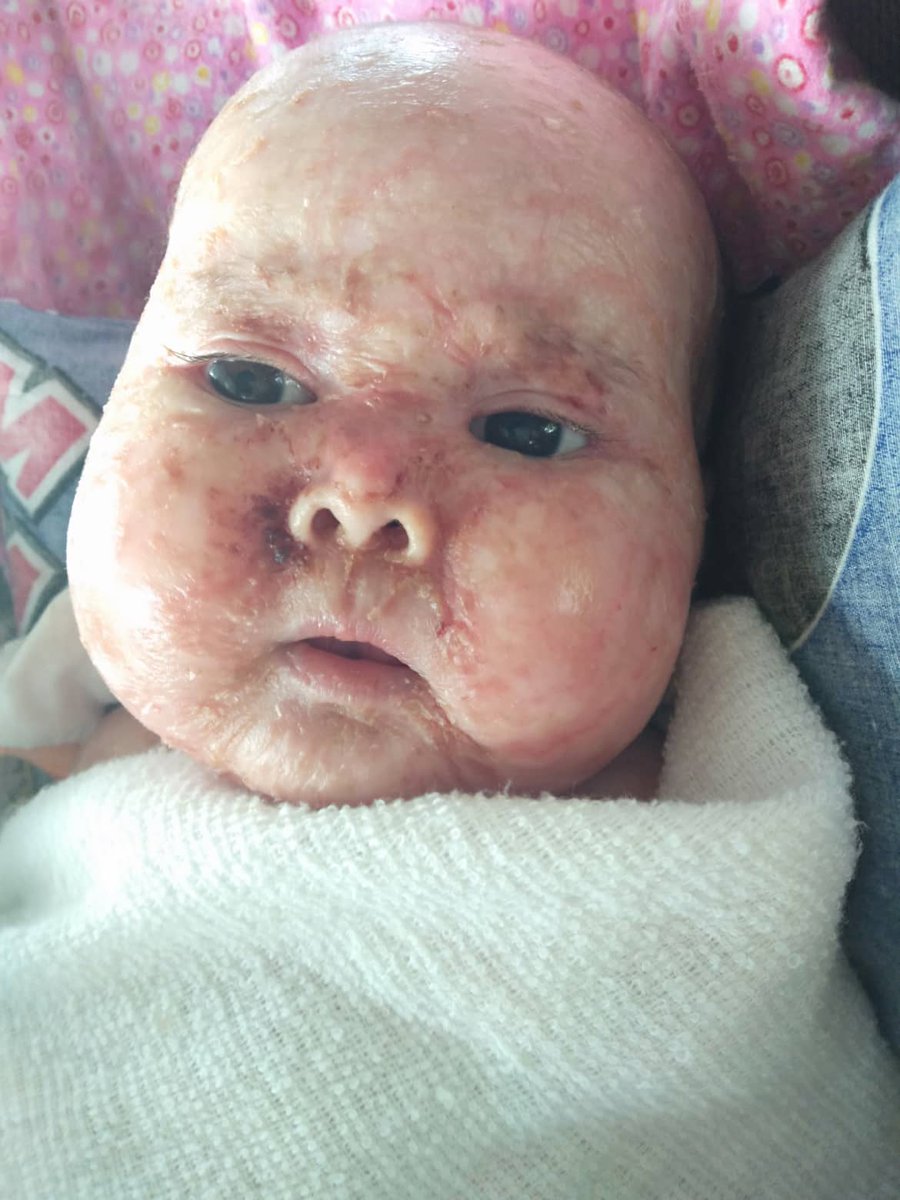 BisekutDinda's tweet photo. Assalamualaikum..disini saya memohon untuk doakan adik airis sofea sembuh dari masalah eczema yg teruk..sis dh pm akk ni untuk bagi sumbangan dan malah dia hanya minta org untuk doakan anak dia sembuh seperti sediakala.. 
.
Rt guys supaya lagi ramai nmpk dan sme sme doakan ❤️ https://t.co/KMigbeyJwM
