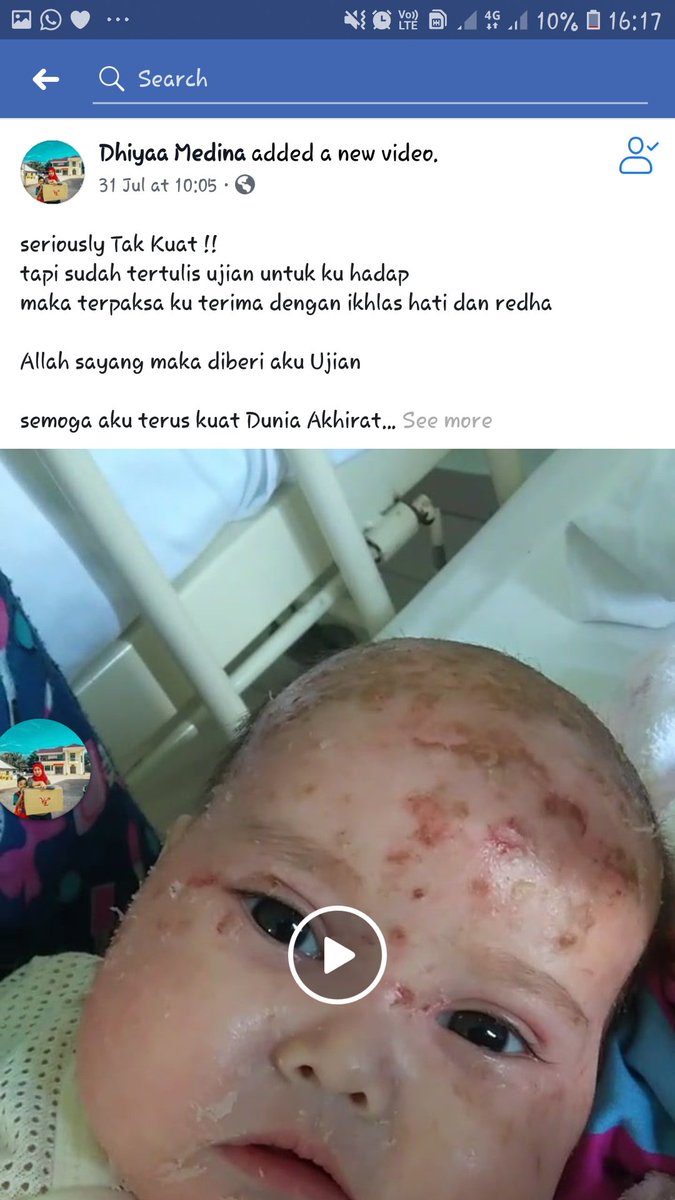 BisekutDinda's tweet photo. Assalamualaikum..disini saya memohon untuk doakan adik airis sofea sembuh dari masalah eczema yg teruk..sis dh pm akk ni untuk bagi sumbangan dan malah dia hanya minta org untuk doakan anak dia sembuh seperti sediakala.. 
.
Rt guys supaya lagi ramai nmpk dan sme sme doakan ❤️ https://t.co/KMigbeyJwM